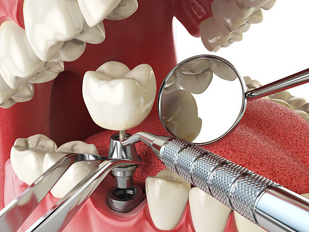 Best Emergency Wisdom Teeth Removal in Bishop, TX
